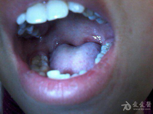 成人口腔疱疹病毒感染