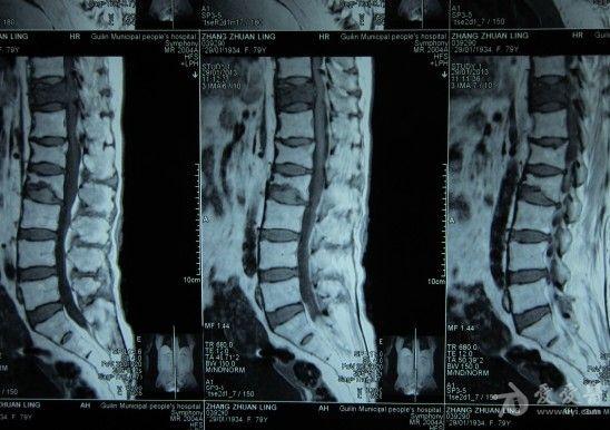 腰1,2椎体压缩性骨折发现胸11椎体破坏讨论