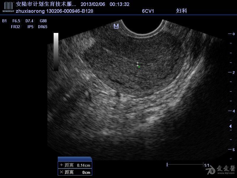 人流后,子宫前壁下段异常回声是什么?