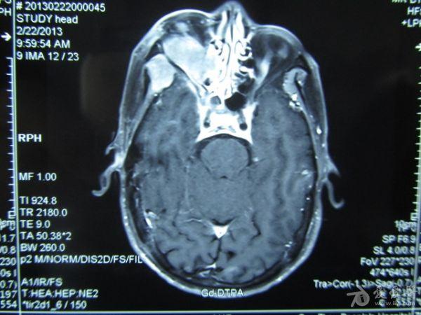 右颞下窝肿瘤 讨论治疗