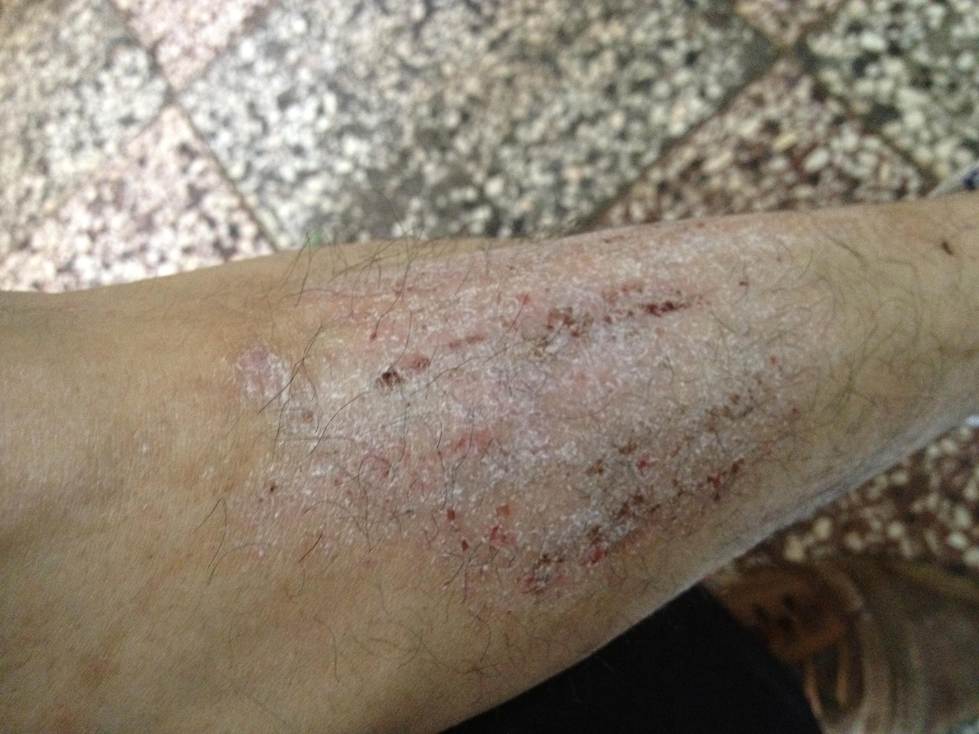 右小腿前部痒痛2年余 皮肤及性传播疾病讨论版 爱爱医医学论坛