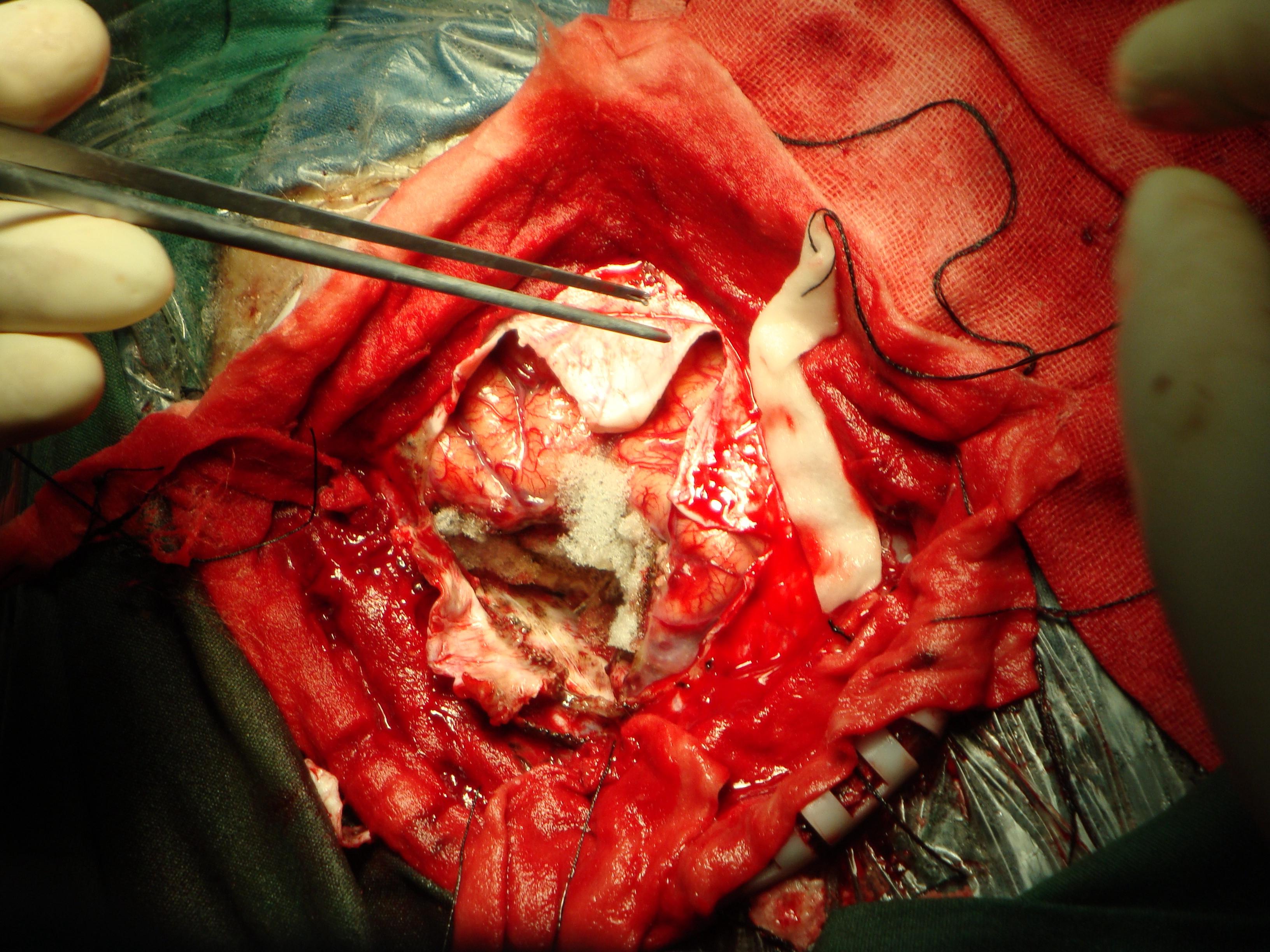 右侧顶叶窦镰旁脑膜瘤一例