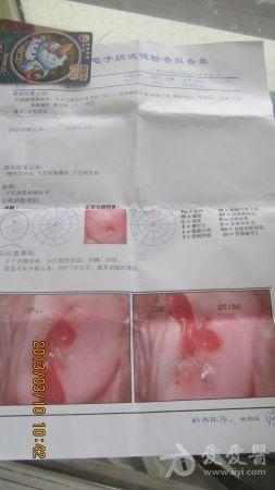 69 白带夹血丝10个月    更正:该患者是2012年7月份做的宫颈息肉