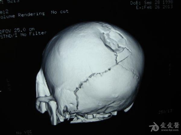 凹陷性颅骨缺损及其颅内压变化的研究进展