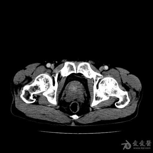 增强,看前列腺内是什么?