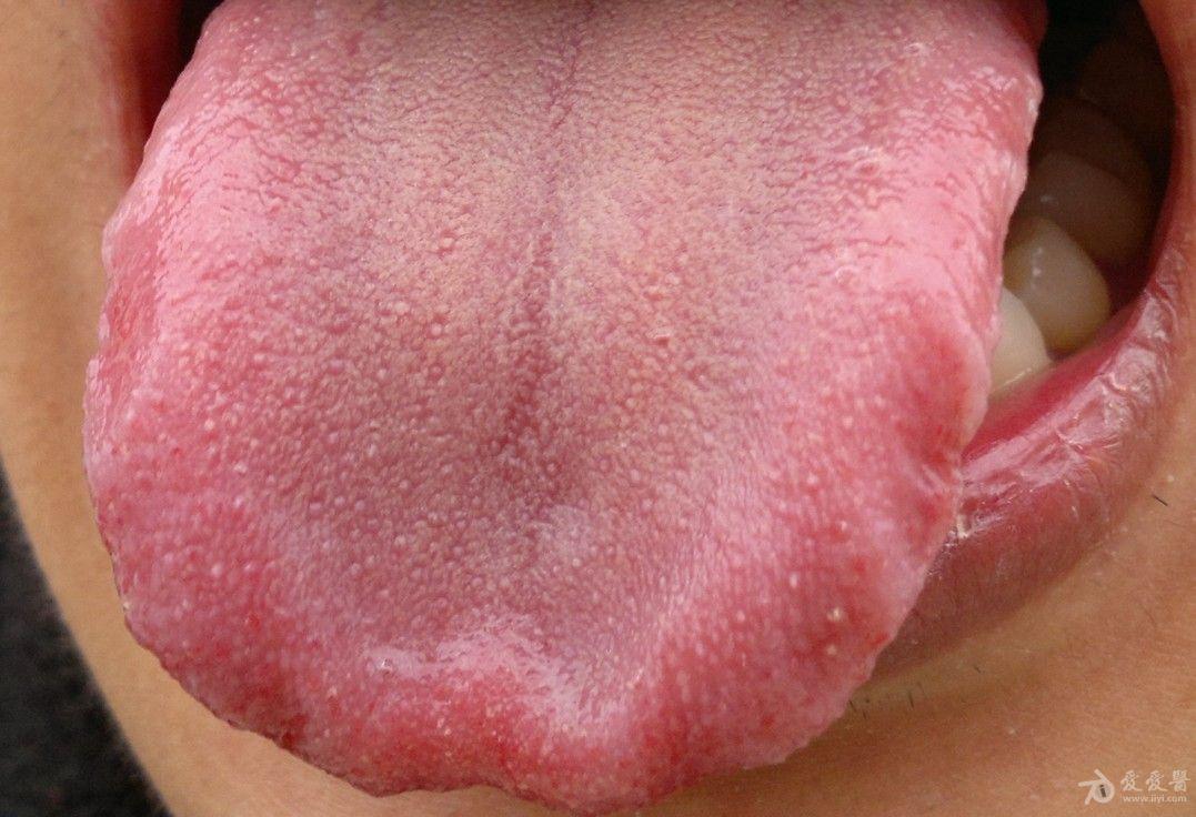用舌头舔过女人(在校大学生,女友)下体,几个月后阴茎包皮系带长出尖锐
