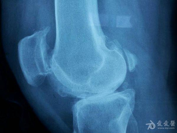 双膝关节严重退行性病变,手术?