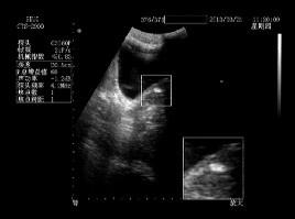 47前列腺内探及一大小约9x4mm强回声光团,请问应该是考虑结石还是钙化