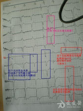起搏器动态心电图怎么看
