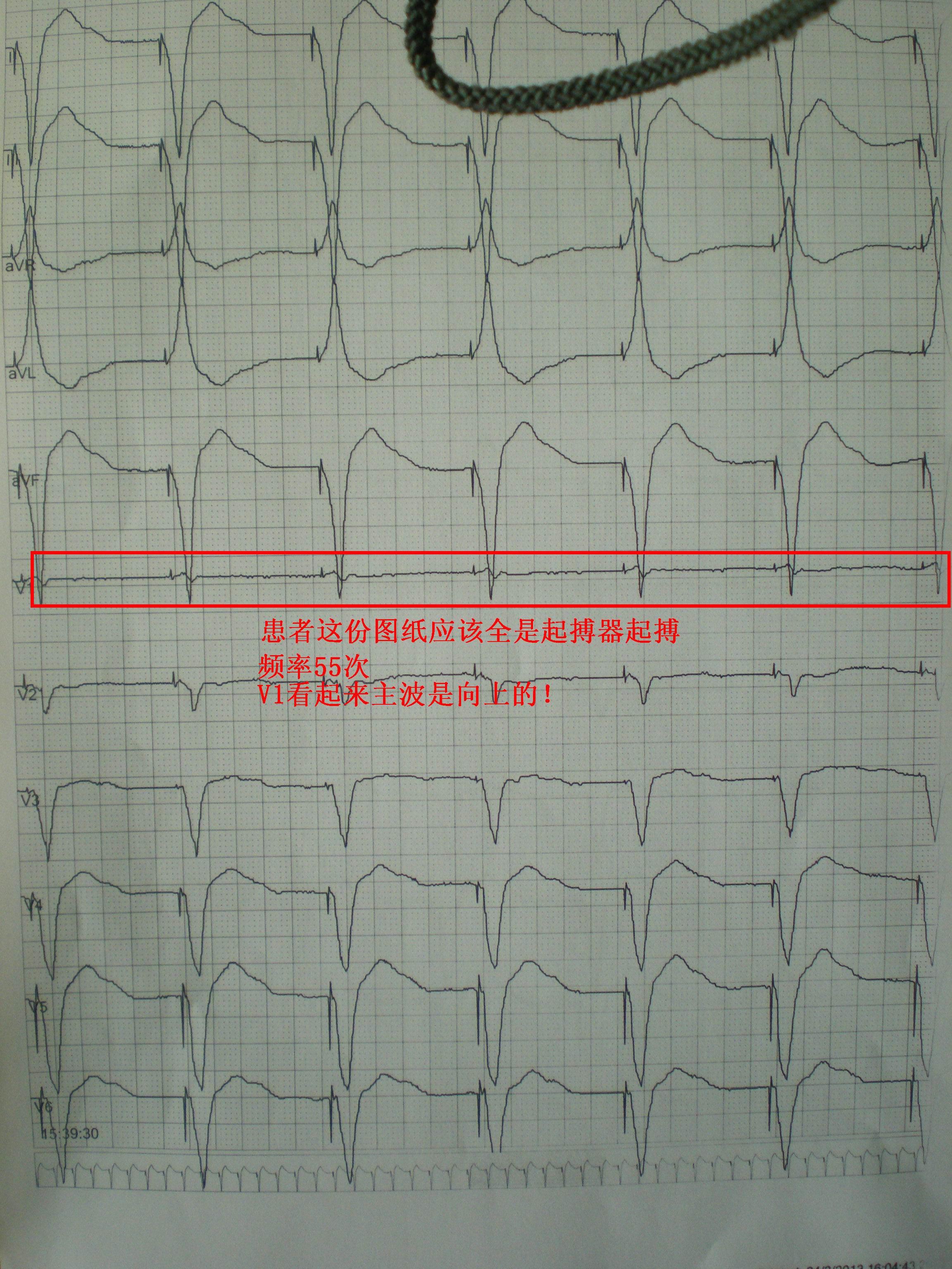 起搏器动态心电图怎么看