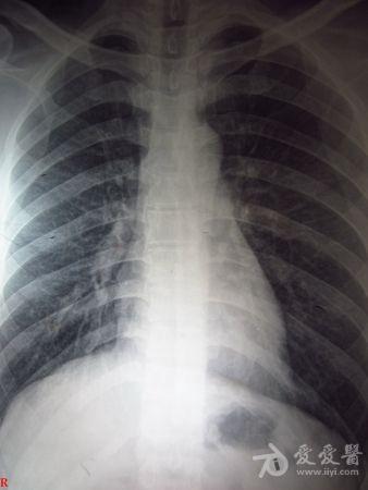 这张胸片肺部有问题吗?