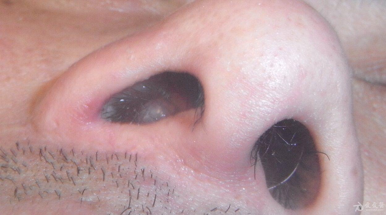 鼻腔巨大息肉
