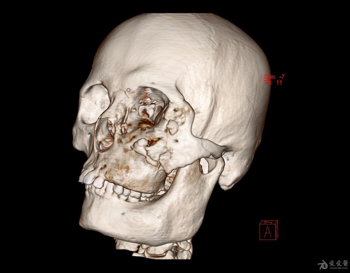 男性头颅ct三维 - 医学影像学讨论版 - 爱爱医医学论坛-爱爱医医学网