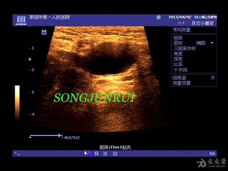 超声入门贴48-腹股沟疝合并精索鞘膜积液