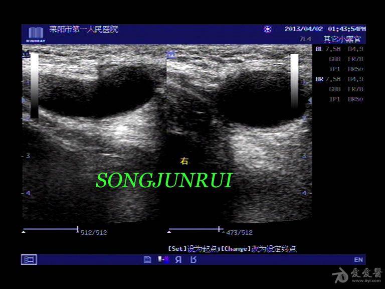 超声入门贴48-----腹股沟疝合并精索鞘膜积液