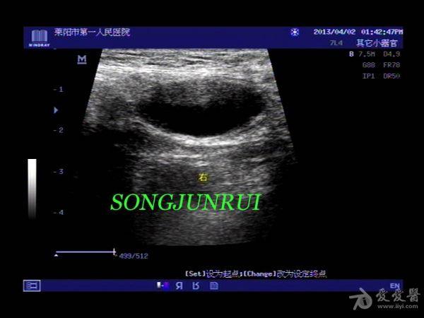 超声入门贴48-腹股沟疝合并精索鞘膜积液