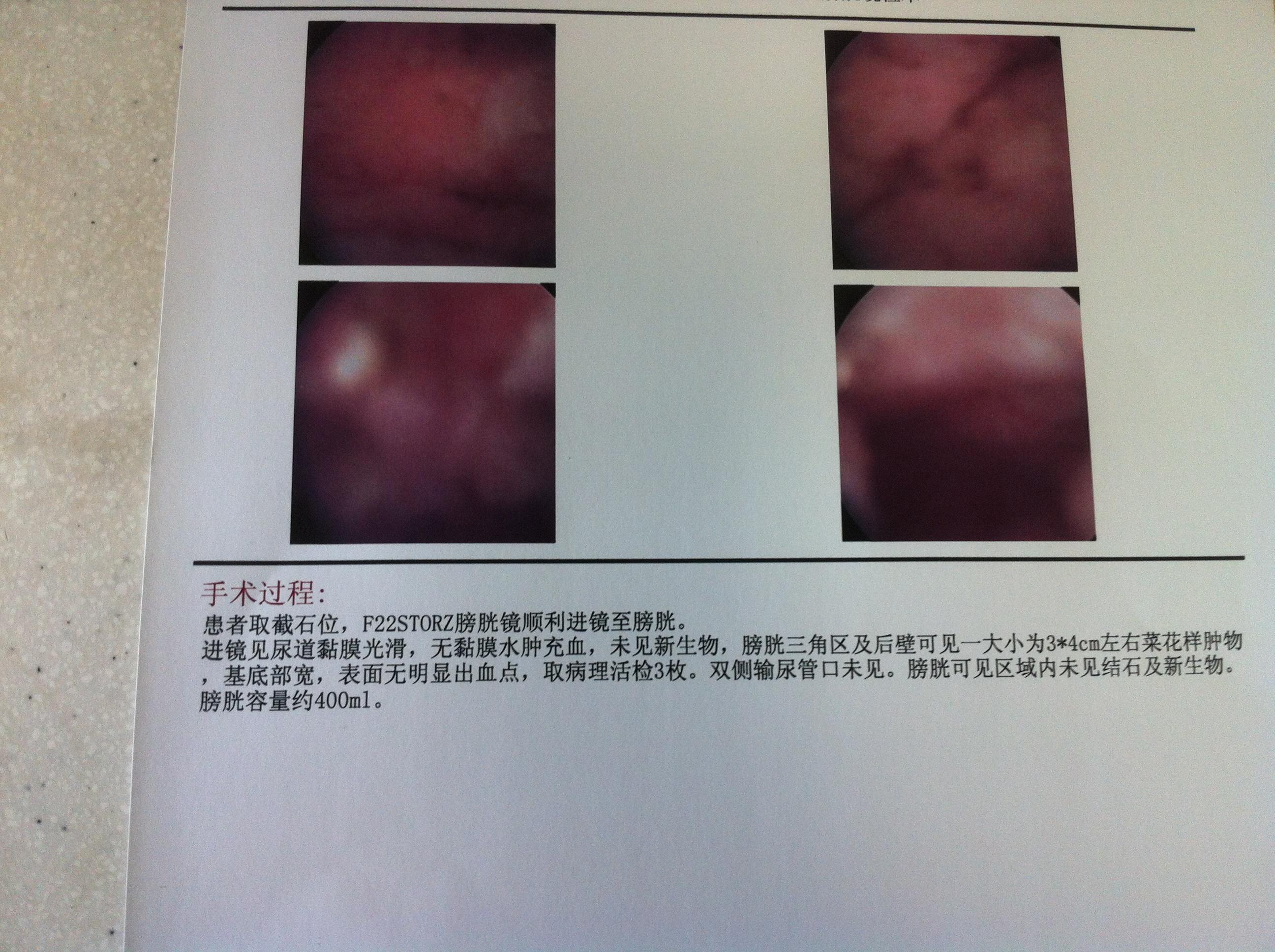 膀胱镜检查,在三角区有3*4cm菜花状肿物,基底部宽,双侧输尿管未见,但