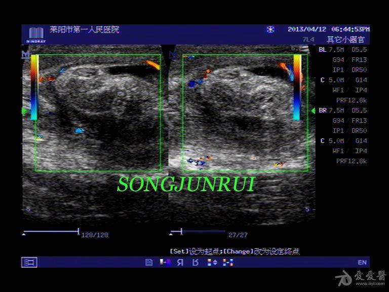 超声入门贴56-----睾丸扭转