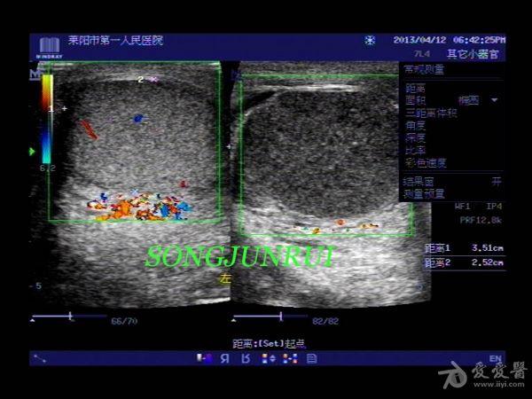超声入门贴56-----睾丸扭转