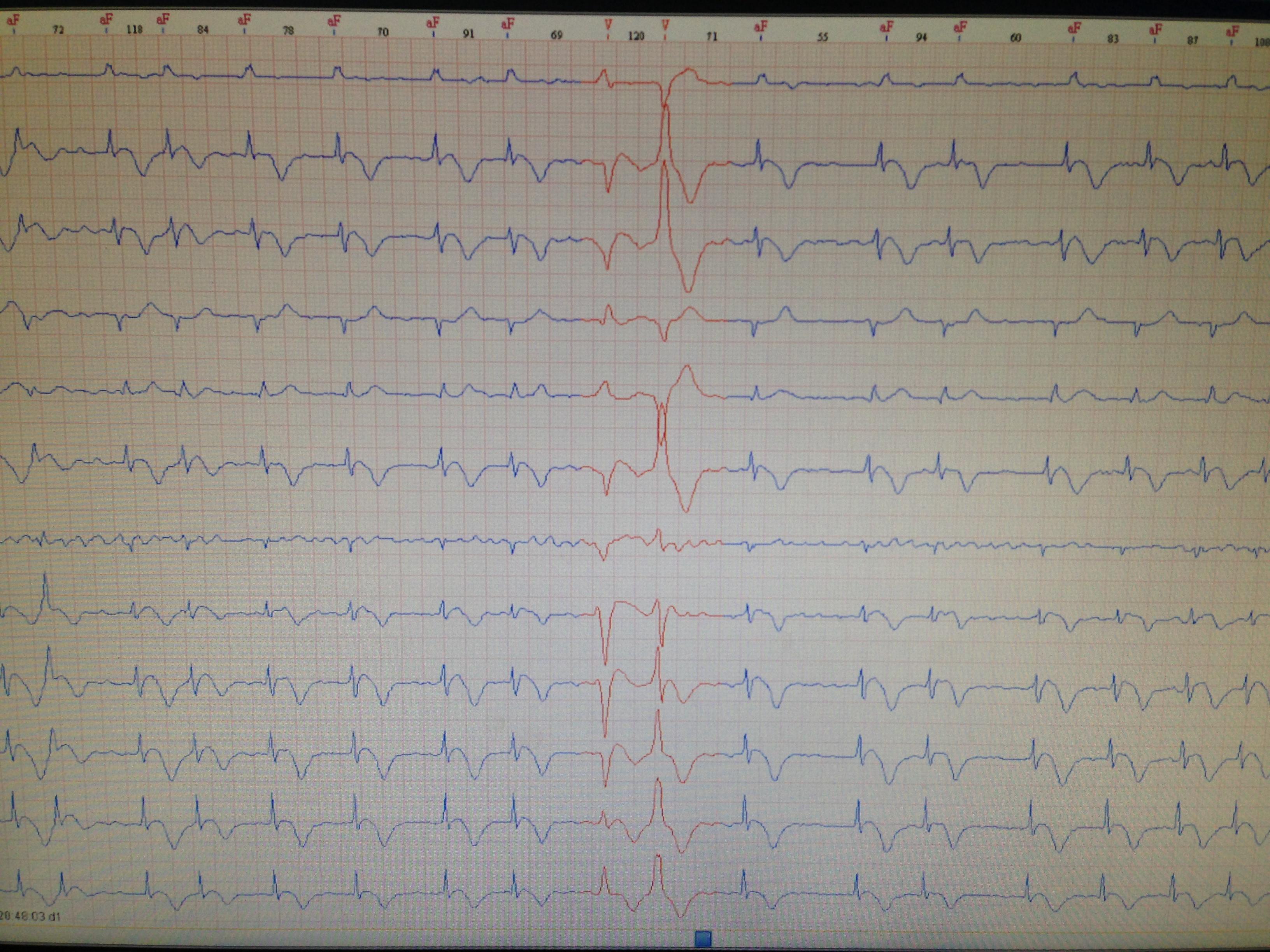 这是一份房颤的心电图 宽大畸形的到底是什么 如何具体鉴别 区别