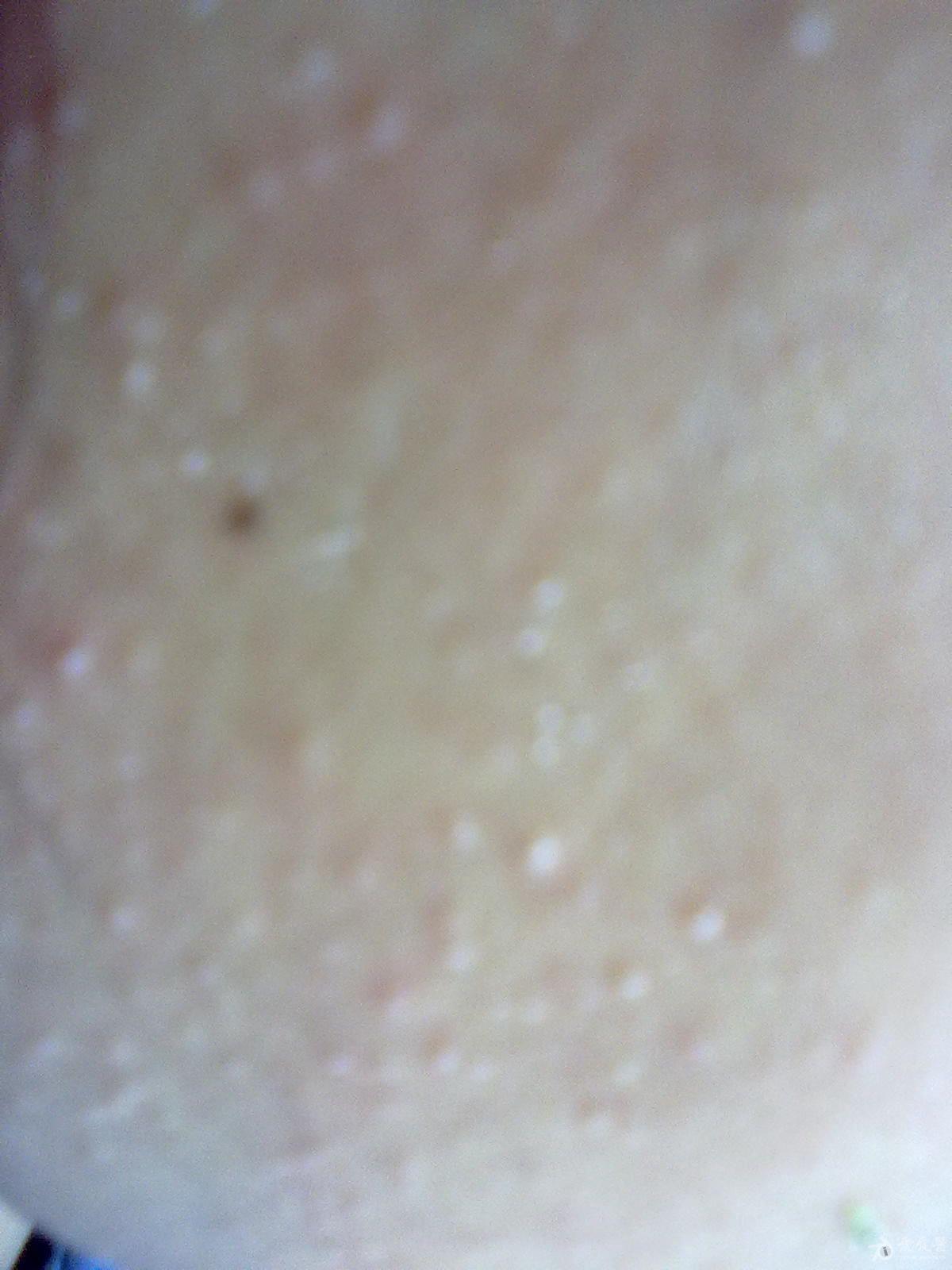 约半年面部小丘疹,请帮助诊断