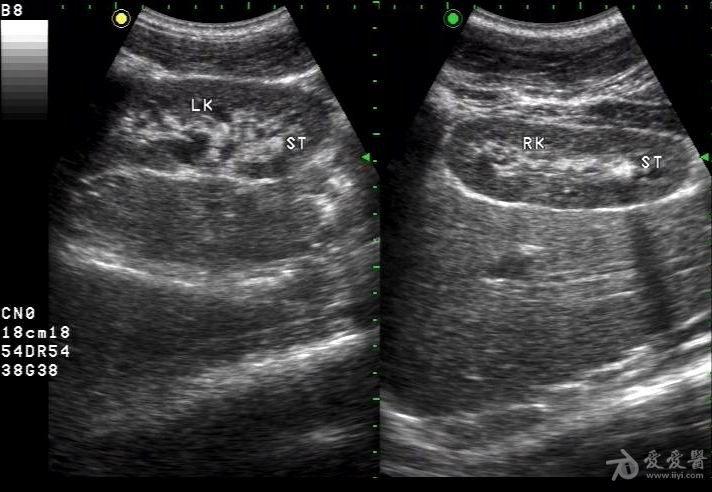楼主dyxhf2013-04-23 21:38:20右肾下盏结石相对明显,左肾下盏结石亦