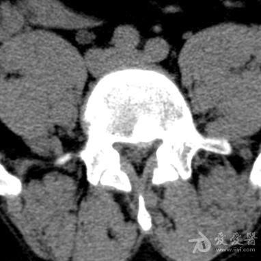 髓核游离(腰4-5间盘).ct mri