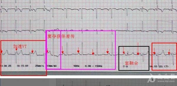 沙发回复可儿9不完全性干扰性房室脱节 伴心室夺获室内差异性传导 不