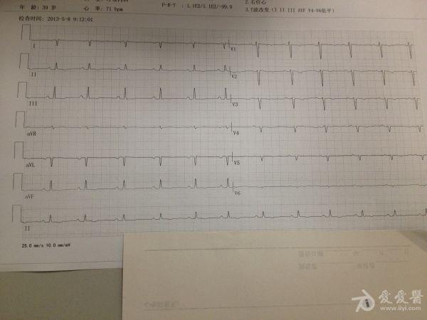 右位心的心电图