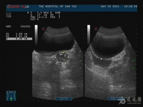 膀胱及前列腺彩超 超声医学讨论版 爱爱医医学论坛 爱爱医医学