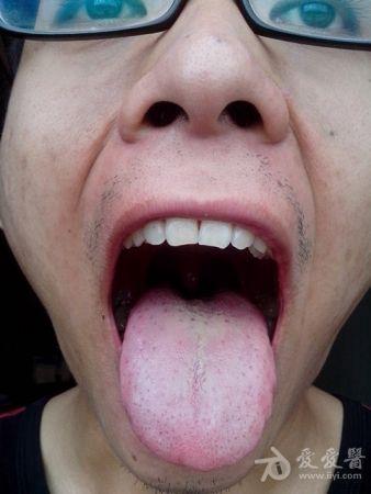 舌根两侧有两个疙瘩 怎么回事 还有舌像请大伙研究研究