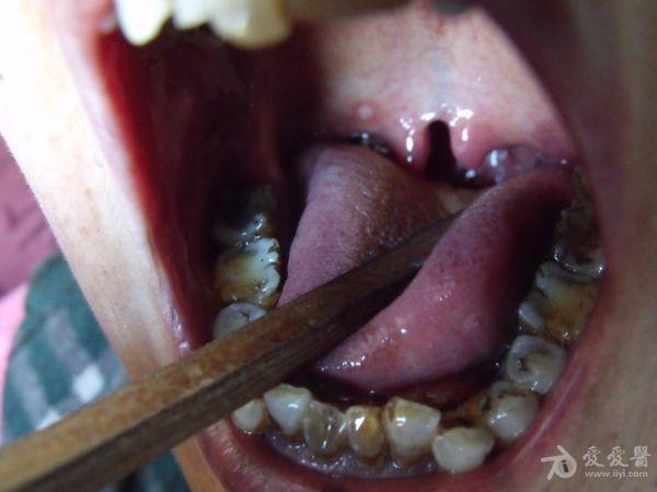 女,蒙古族,55岁,发音及饮食吞咽无明显异常,因口腔溃疡来我处就诊