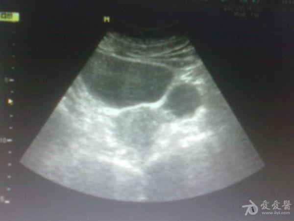左侧卵巢囊肿 超声医学讨论版 爱爱医医学论坛 爱爱医医学网