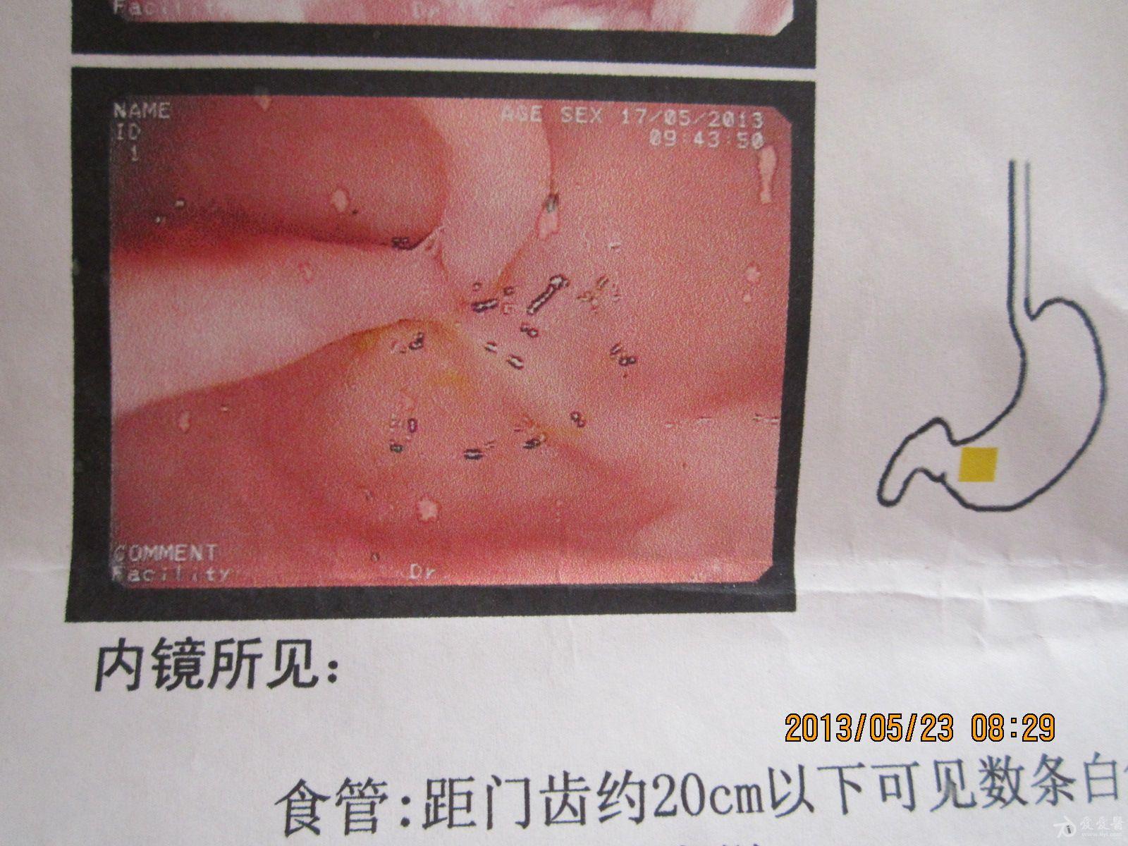 霉菌性食管炎