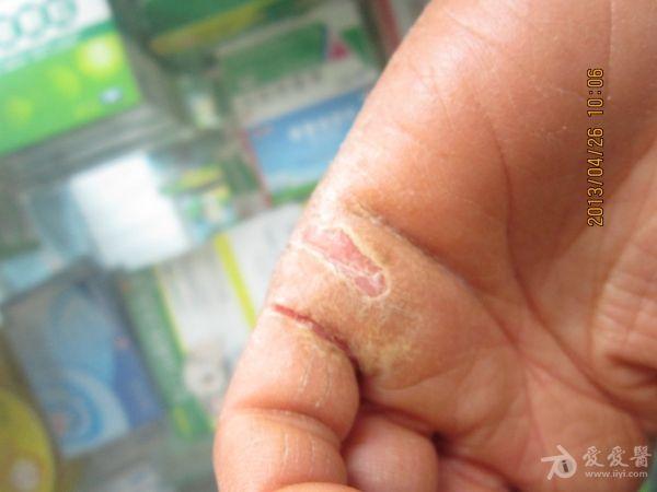 连续性指端皮炎,掌趾脓疱病?