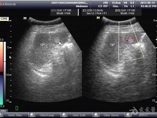 脾脏占位 - 超声医学讨论版 - 爱爱医医学论坛 - 爱爱