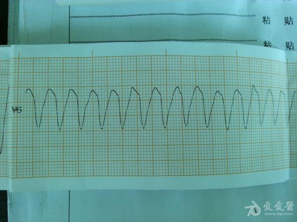 请教一份心电图诊断