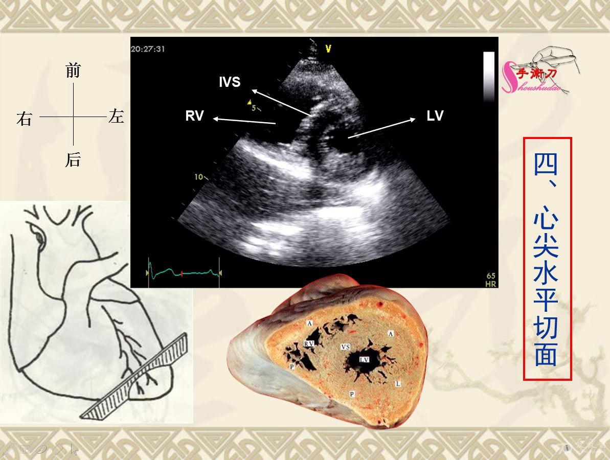 超声心动图基础切面打法图解(初学者可参考)