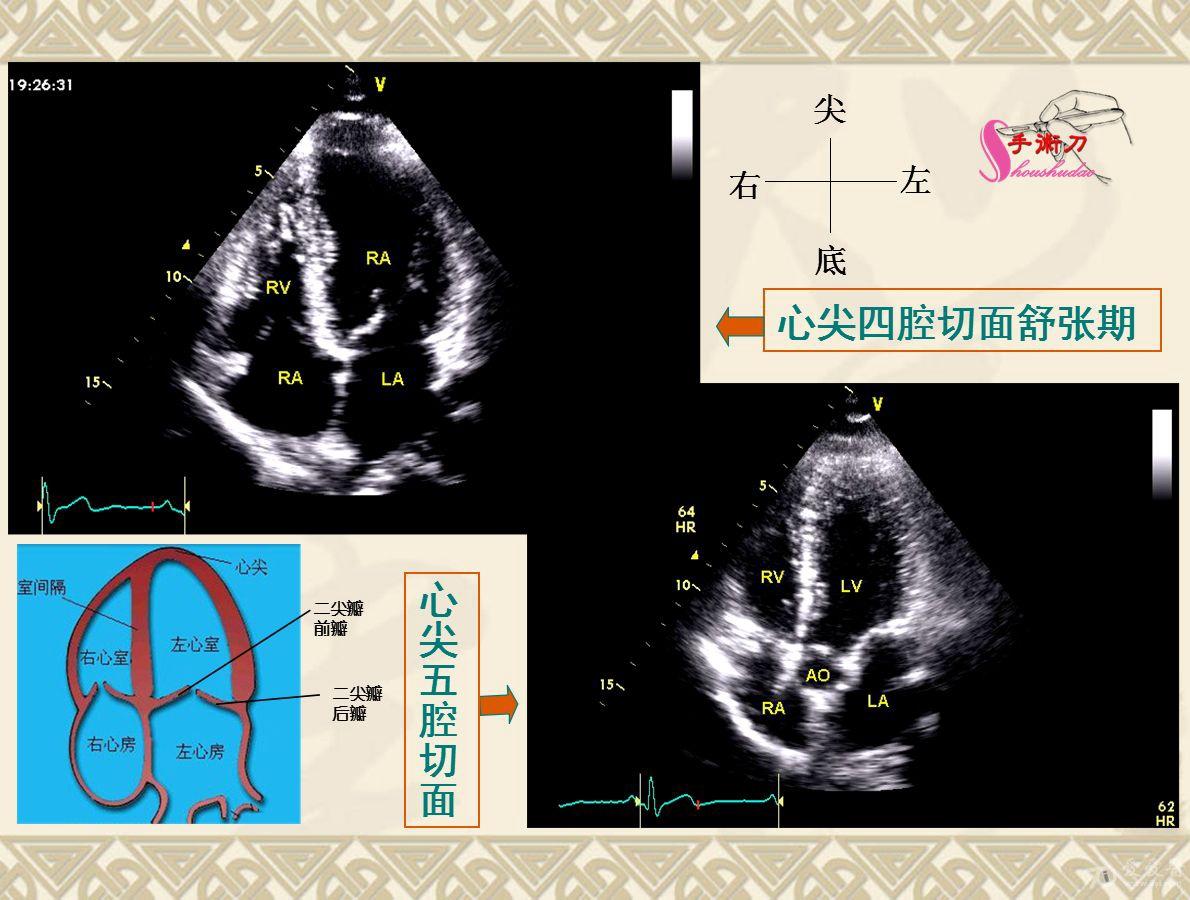 超声心动图基础切面打法图解(初学者可参考)