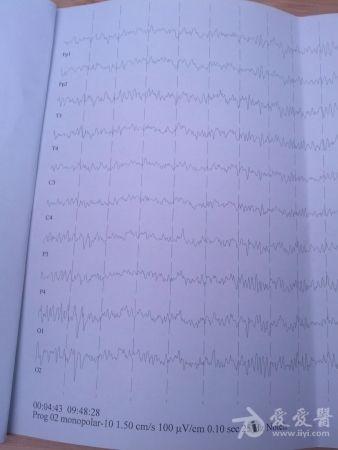 4岁小儿脑电图求解