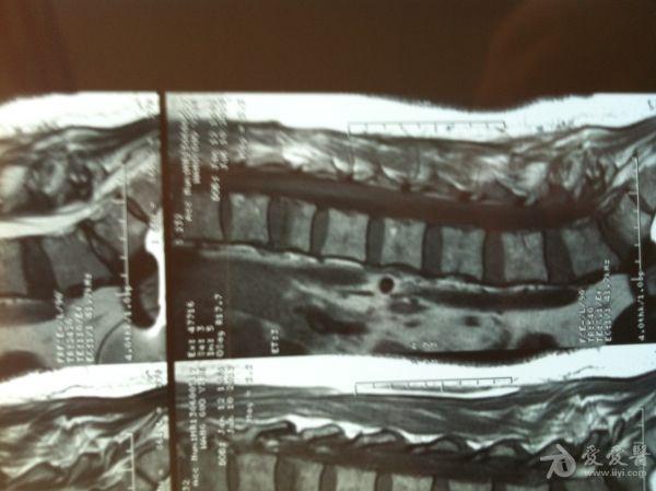 12胸椎骨折