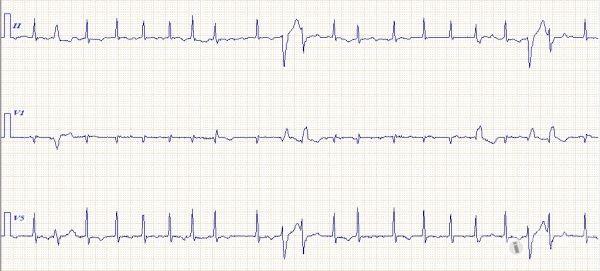求助心电图 20130614