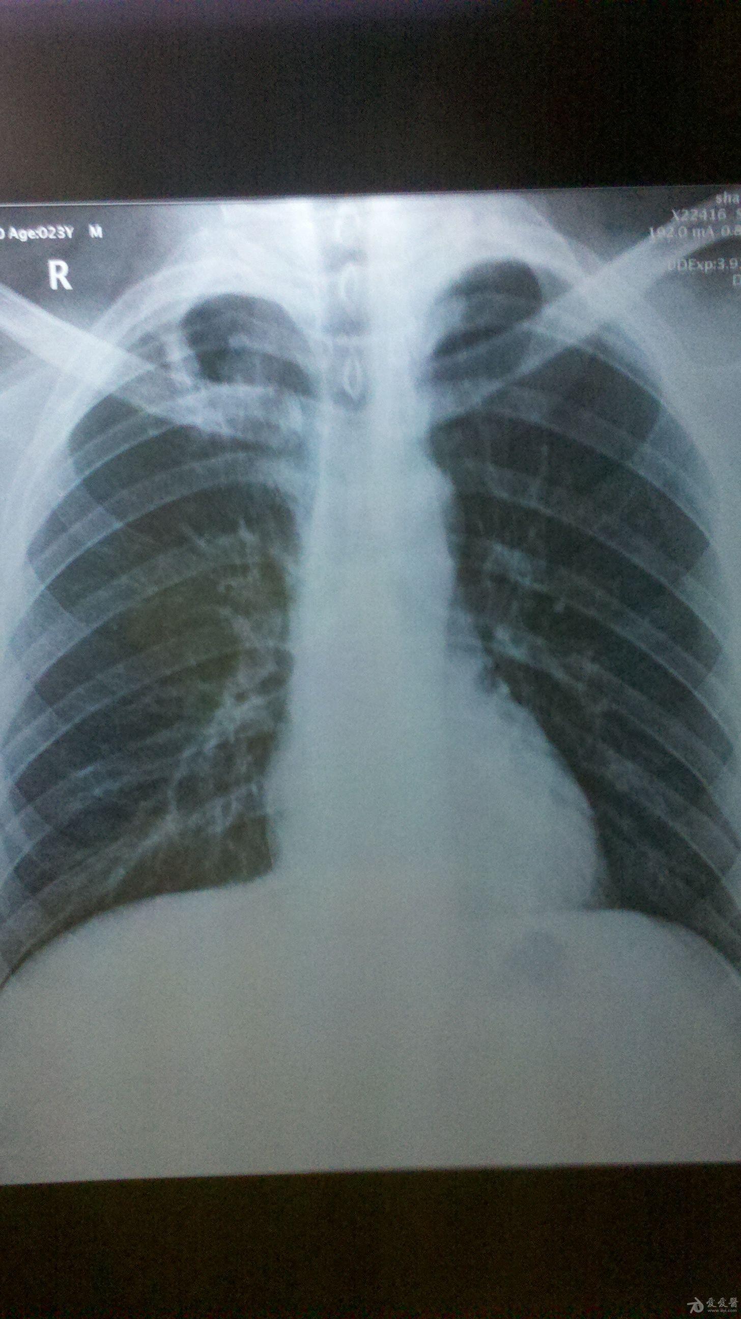 患者一年前曾咳嗽3-4个月左右,如今无任何肺结核症状,不咳嗽也不盗汗