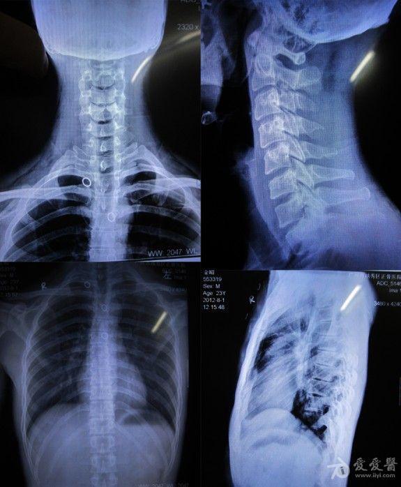 请影像专家帮我读下颈胸椎x片