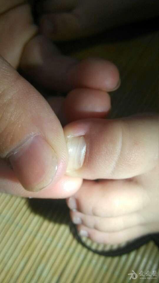 14个月宝宝大脚趾甲根部断裂是怎么回事?