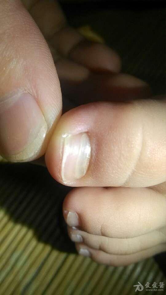 14个月的宝宝脚趾甲根部整个断裂是怎么回事?