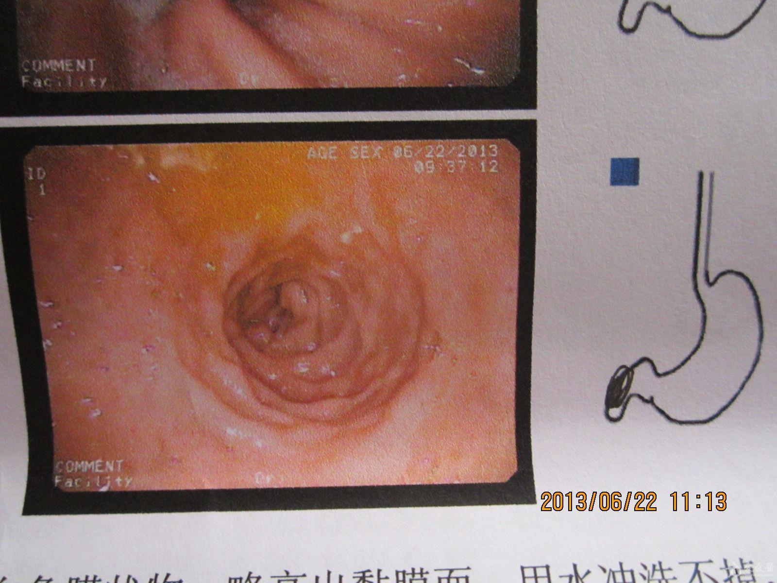 霉菌性食管炎