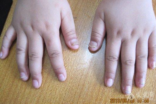小孩的指甲是什么病