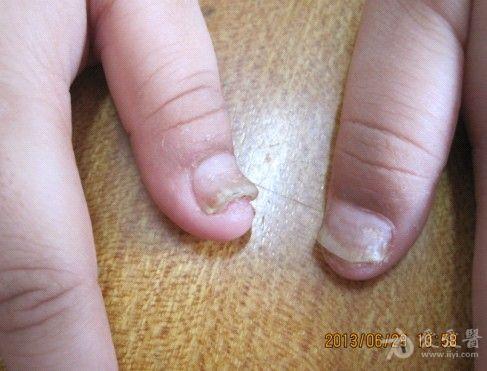 小孩的指甲是什么病