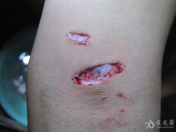 在不明确是否为疯动物的情况下,常规处理伤口,接种狂犬疫苗外